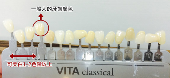 牙齒美白